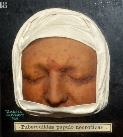 tuberculides