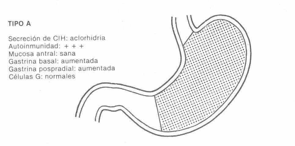 Cómo saber si tengo una úlcera gástrica o gastritis? - FCV