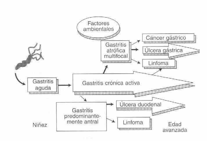 gastritis05