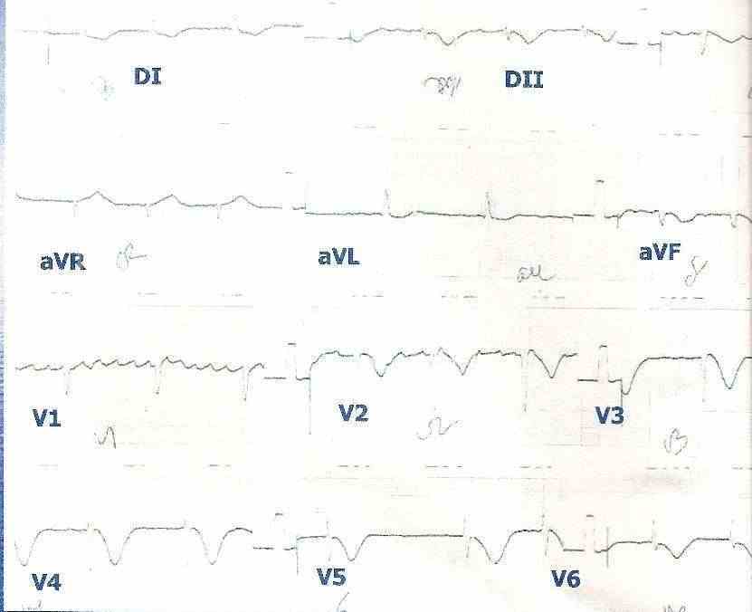 infarto5