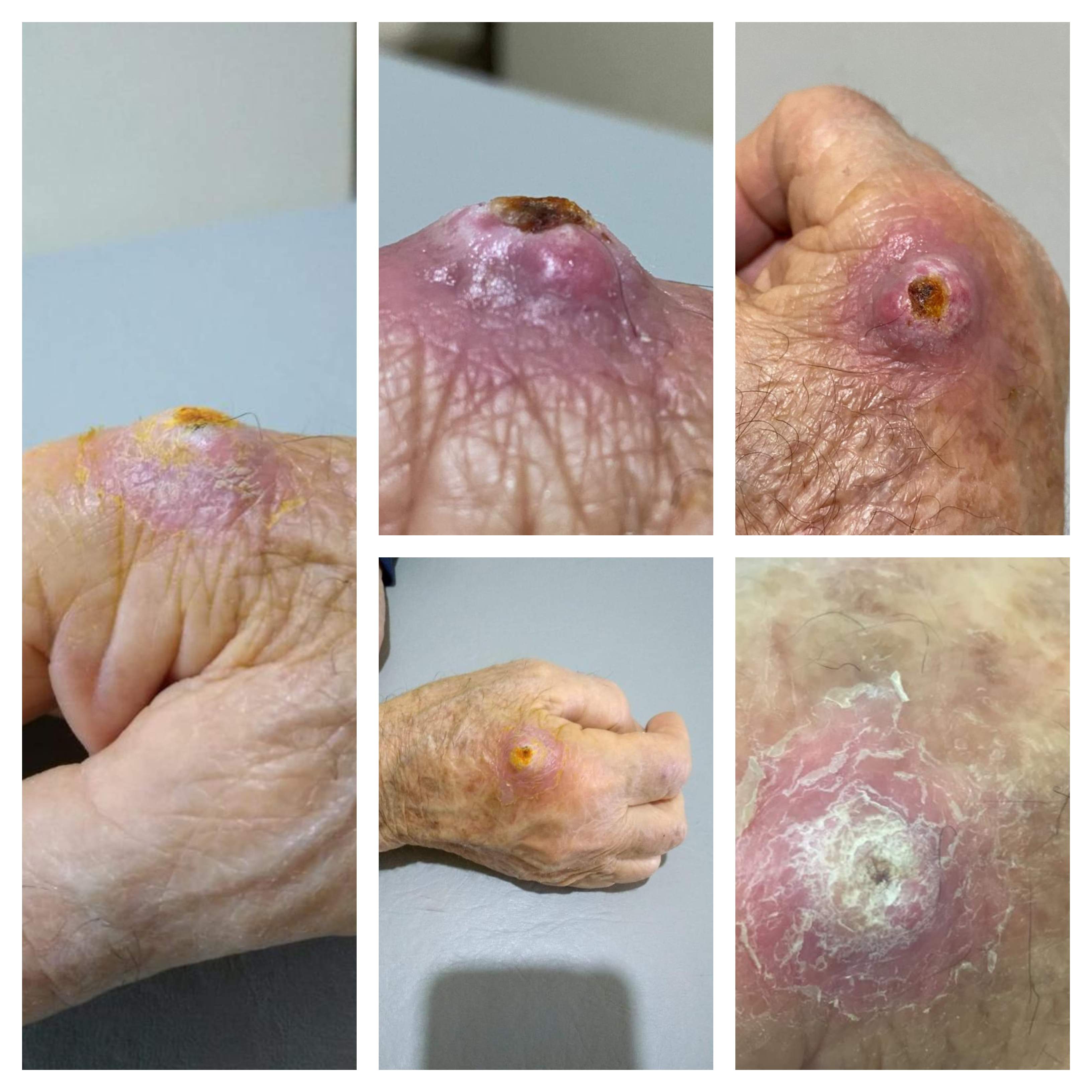3-cuernocutaneocuracion
