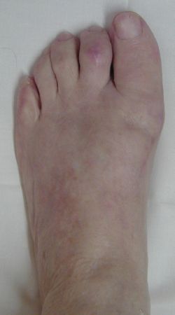 Reparación quirúrgica de Hallux Valgus