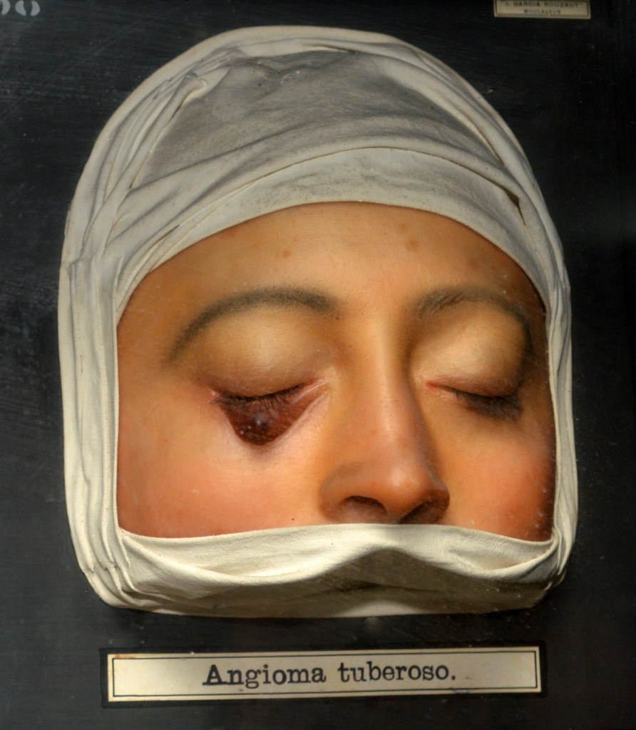 angioma_tuberoso