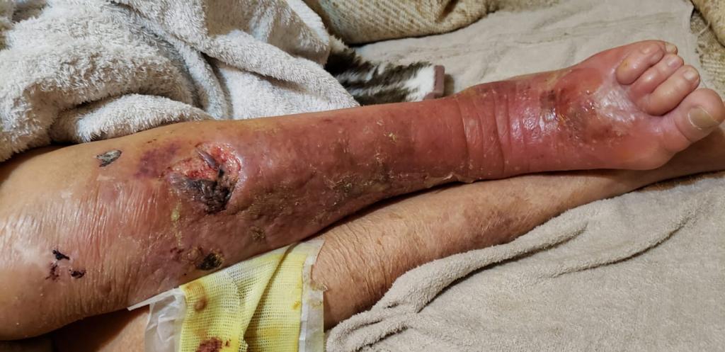 celulitis01
