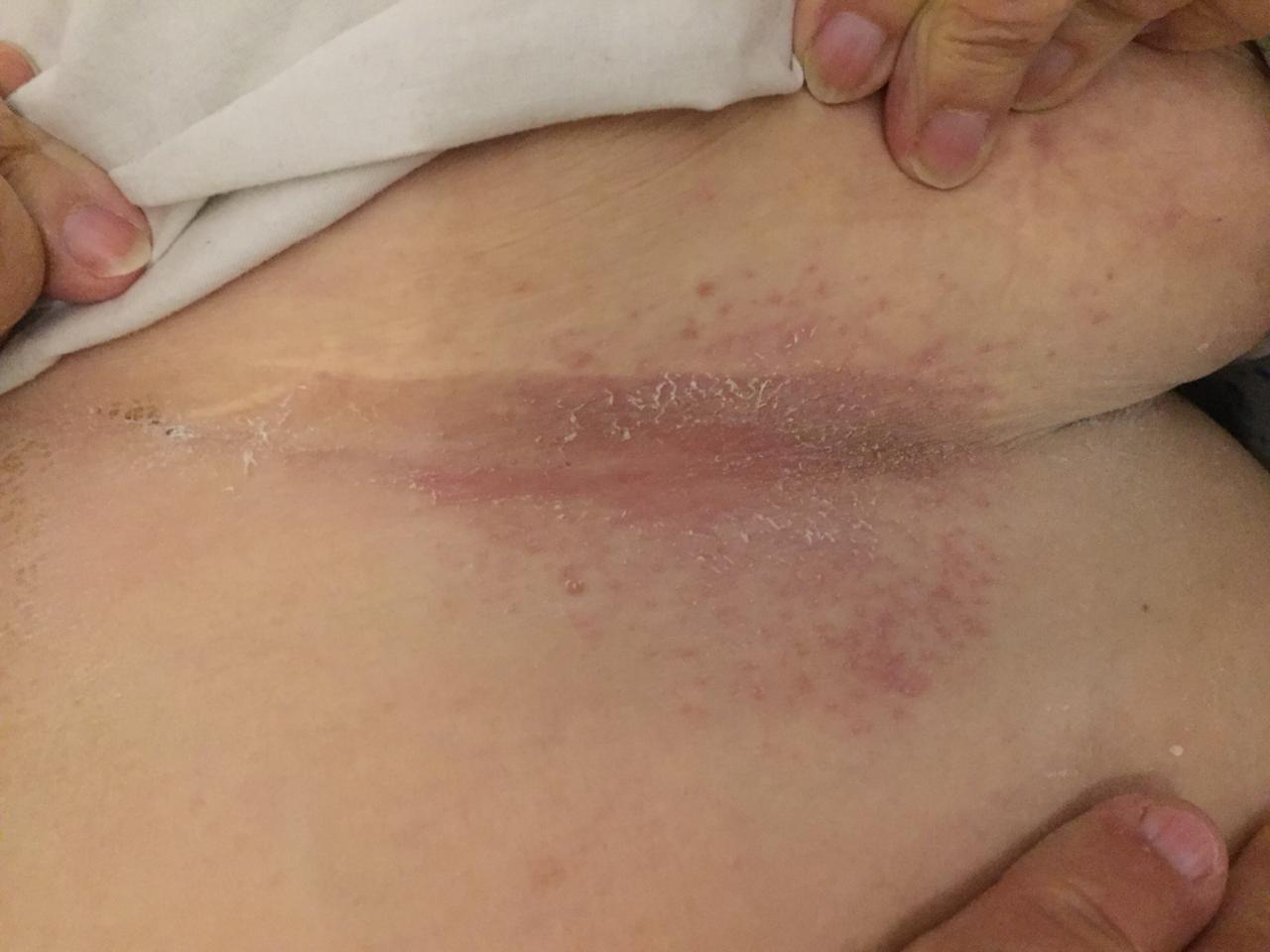 dermatitissubmamaria