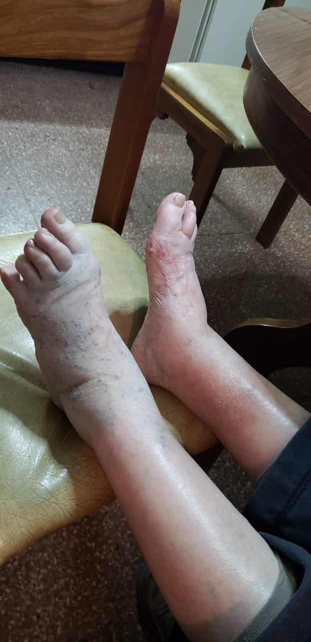 Edema unilateral