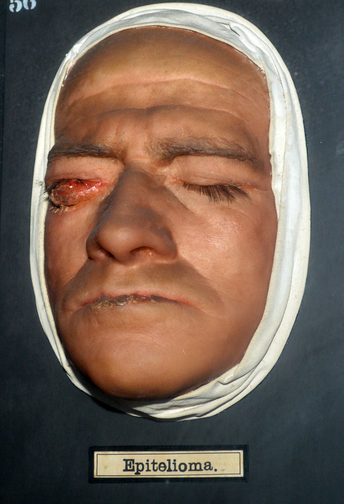 epitelioma2