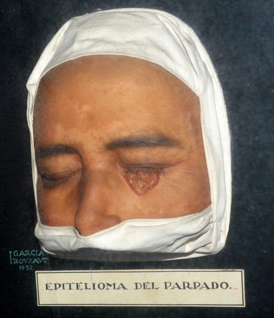 epitelioma4