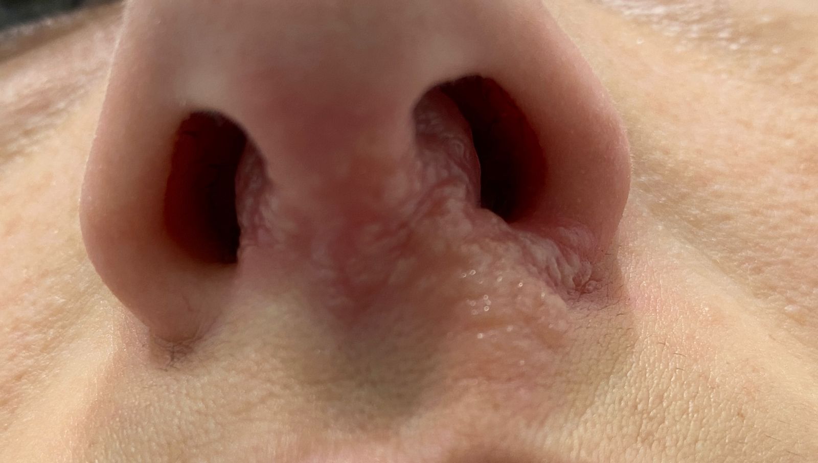 herpesnasal