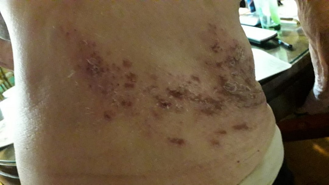 herpeszoster7