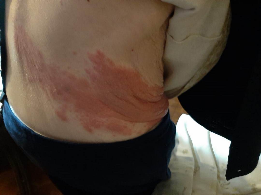 herpeszoster9