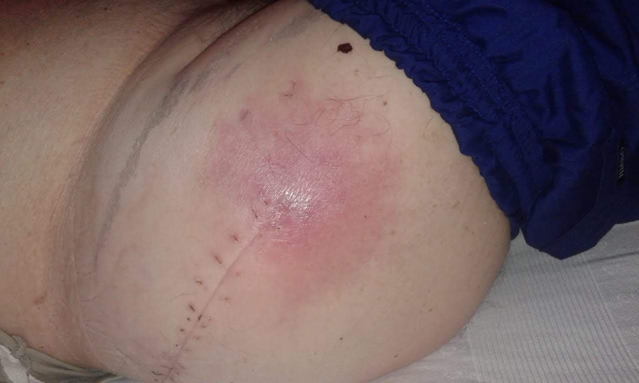 infeccion_de_protesis_cadera