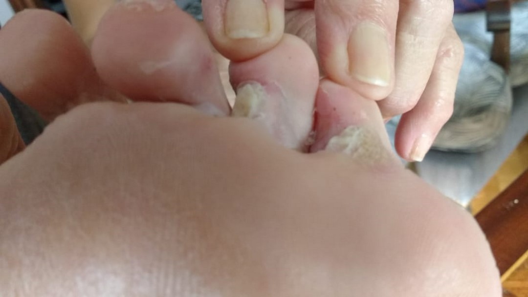 micosis