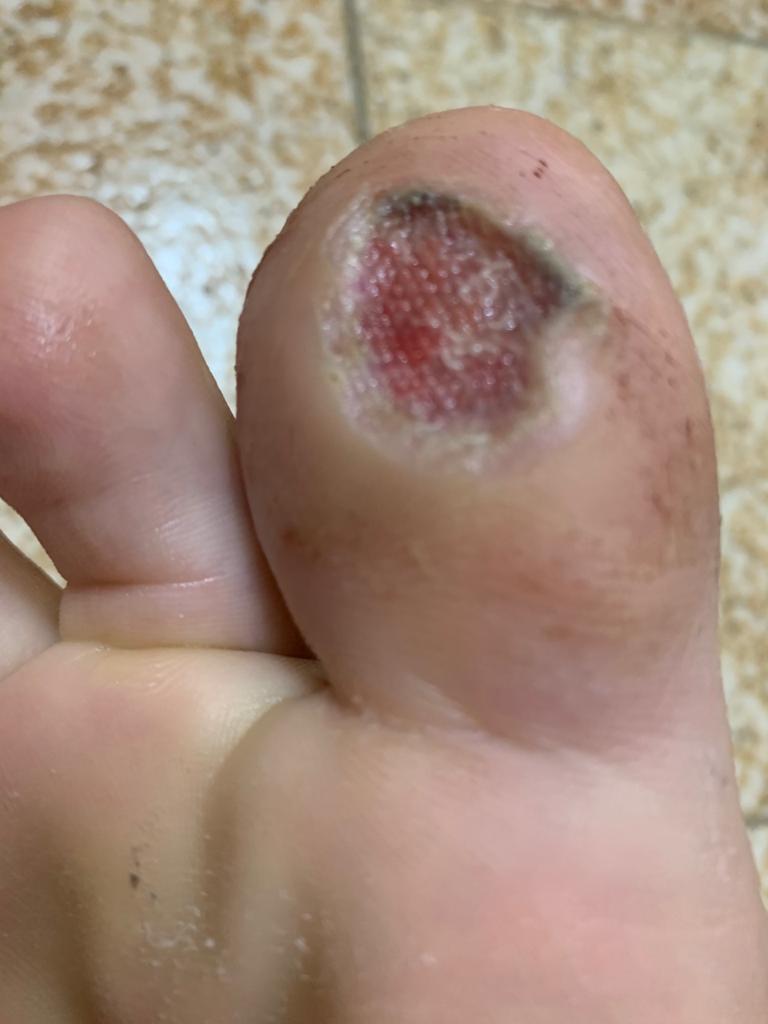 mordeduradepalometacuracion