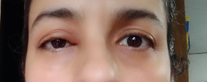 ptosis01