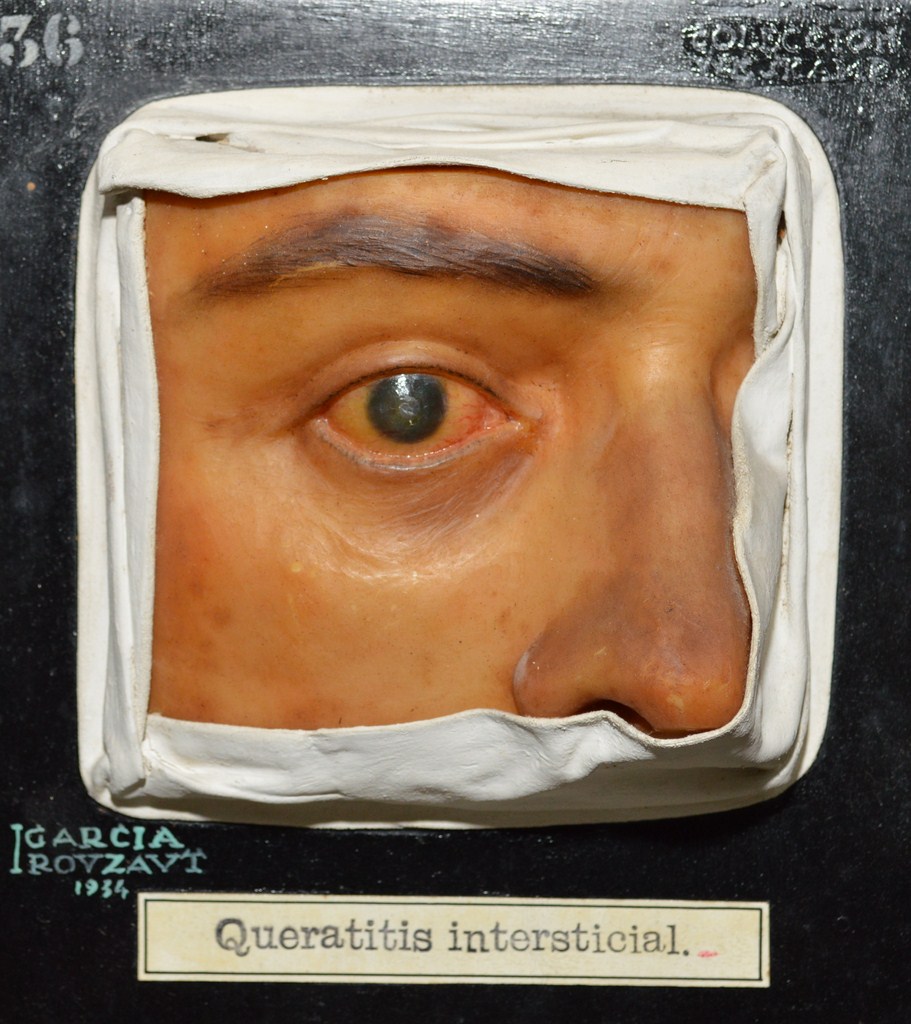 queratitis_intersticial