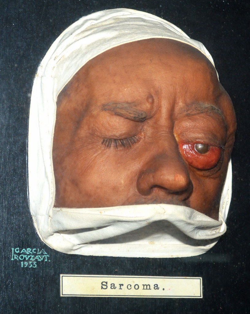 sarcoma2