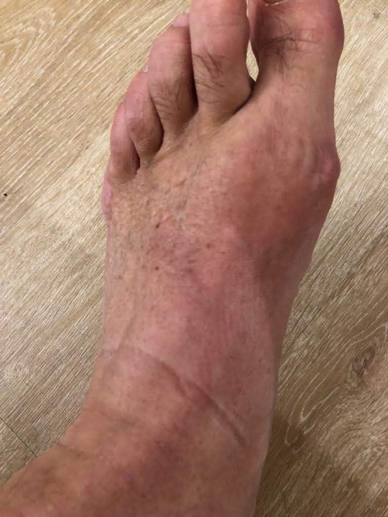 Tendinitis