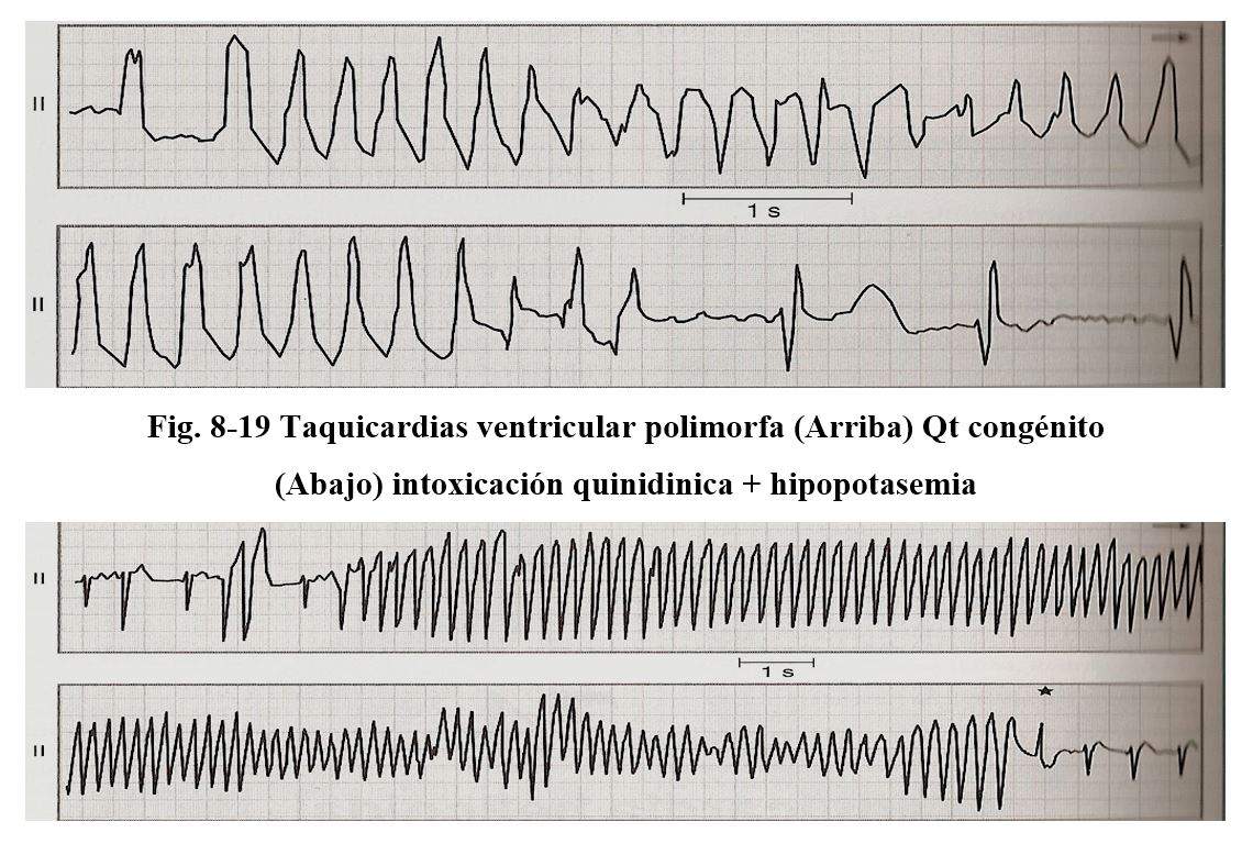 arritmia18